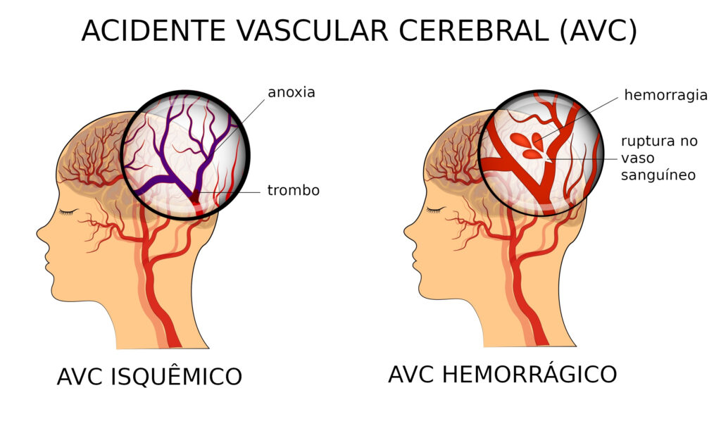 tipos de AVC